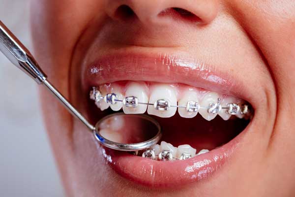 إصلاح الأسنان في تركيا