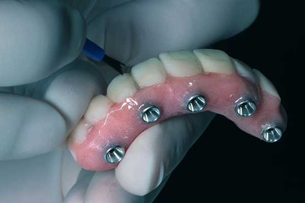 احدث تقنيات زراعة الاسنان