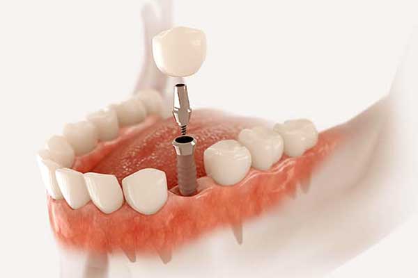 الأسنان الاصطناعية أشهر الأنواع و طرق التركيب و كيف تختار ما يناسبك؟