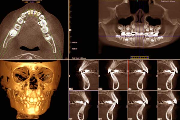 تصوير الأشعة السينية ثلاثية الأبعاد والتخطيط الرقمي للعملية: مستقبل طب الجراحة