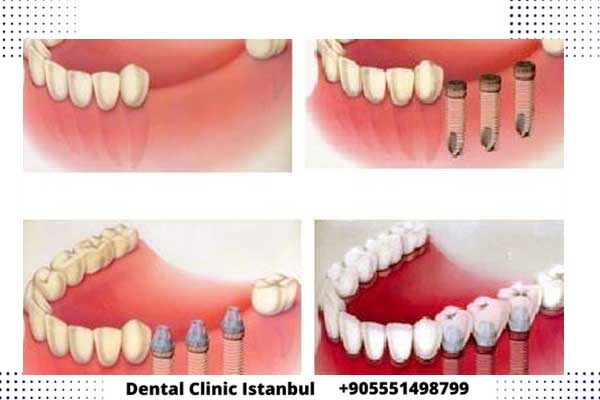 أنواع زراعة الأسنان في تركيا - المراحل و التقنيات و الأسعار