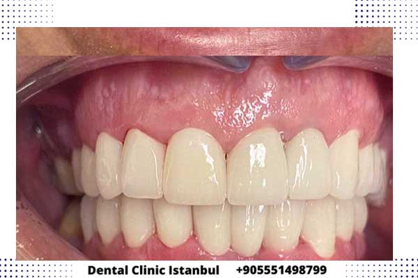 تقويم الأسنان في تركيا – الأنواع و الأسعار و المميزات