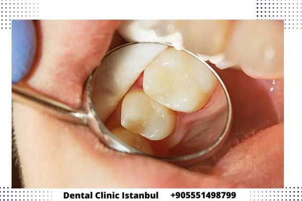 حشو الأسنان في تركيا – الأنواع و الأسعار وأفضل الحشوات