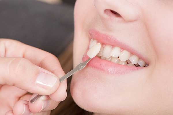 عدسات أسنان بدون نحت : الابتكار في تجميل الابتسامة