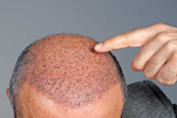 زراعة الشعر في اسطنبول