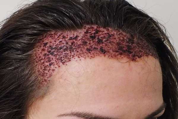 تكلفة زراعة الشعر في تركيا: دليل شامل لعلاج فعال وبأفضل الأسعار