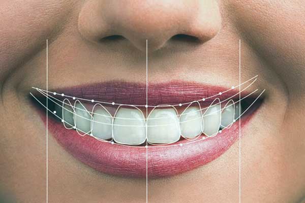 تكلفة ابتسامة هوليود في تركيا: كل ما تحتاج معرفته