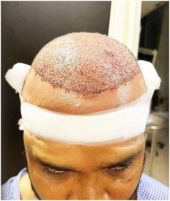 متى يمكن الخروج بالشمس بعد زراعة الشعر