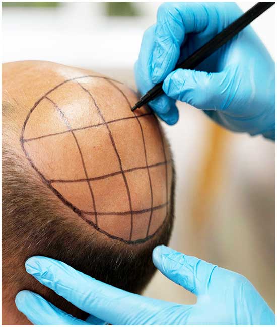 المناطق المانحة في زراعة الشعر ما هي وكيف تستخدم في الزراعة