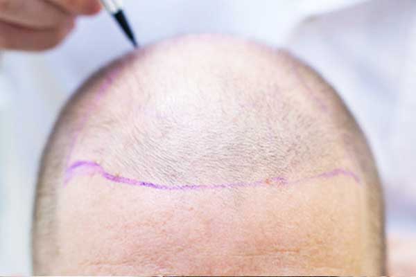 واش المشي مفيد لزراعة الشعر؟ كل ما خاصك تعرف فـ 2024