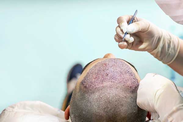 هل توجد أضرار لزراعة الشعر؟ نظرة شاملة على المخاطر المحتملة في 2024