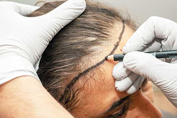 متى يمكن التعرق بعد زراعة الشعر؟ دليل شامل للعناية المثالية في 2024