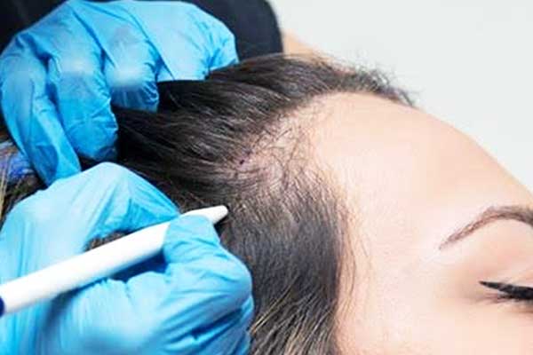 الأدوية بعد زراعة الشعر: دليل شامل للشفاء والنتائج المثالية