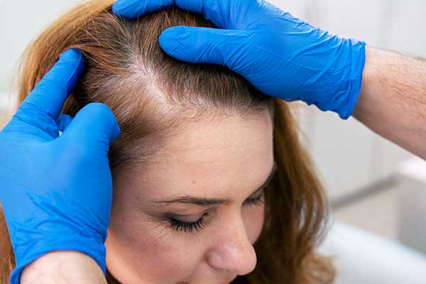 الشامبو الطبي بعد زراعة الشعر: دليلك الشامل للعناية بالشعر المزروع