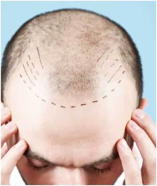 متى تثبت البصيلات بعد زراعة الشعر؟ دليل شامل لضمان نجاح العملية