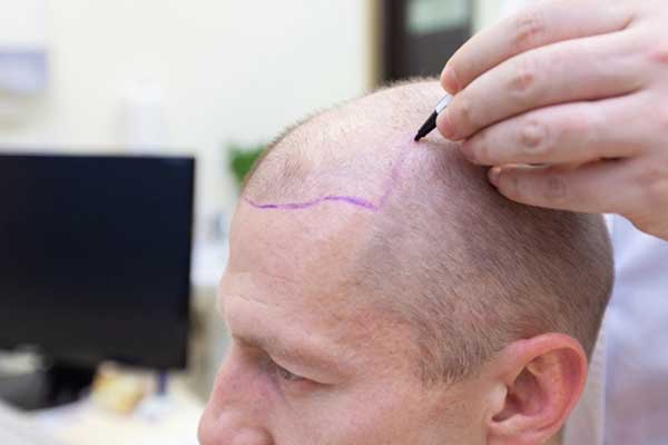 افضل مراكز زراعة الشعر في تركيا: دليل شامل لاختيار العيادة المثالية