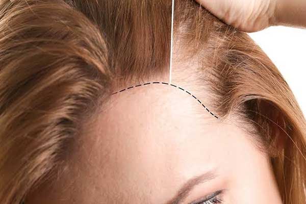 زراعة الشعر في تركيا للنساء