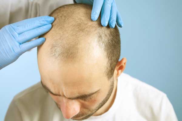 افضل دكتور زراعة شعر في تركيا