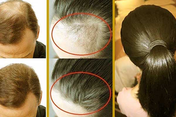 تجربتي مع زراعة الشعر في تركيا