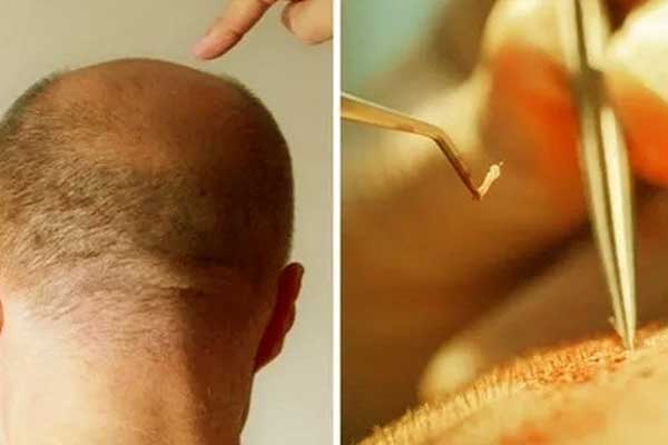 زراعة الشعر بالخلايا الجذعية في تركيا: الحل الحديث لاسترجاع شعرك بأفضل طريقة