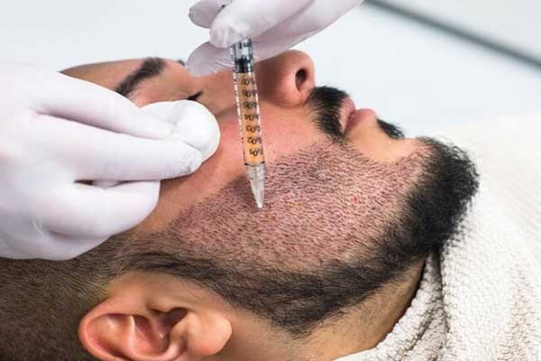 عروض زراعة الشعر في تركيا