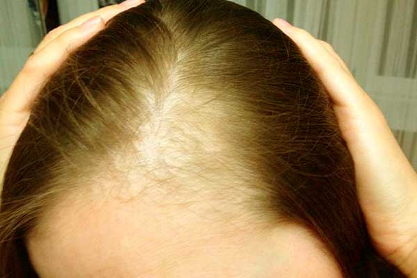 افضل اماكن زراعة الشعر في تركيا