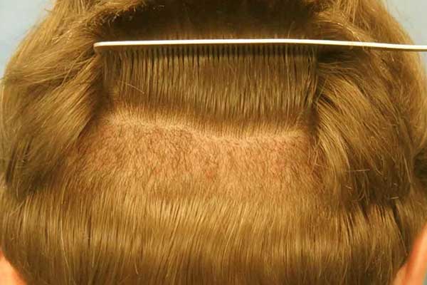 أفضل 5 مستشفيات زراعة الشعر في اسطنبول – دليل شامل لعام 2024